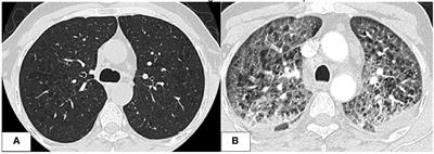Azacitidine induced lung injury: report and contemporary discussion on diagnosis and management
